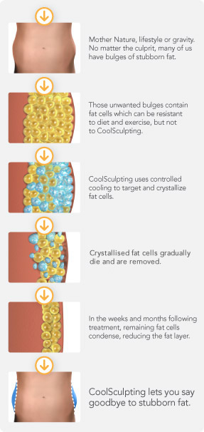 CoolSculpting - Artisan Clinic  Fortitude Valley
